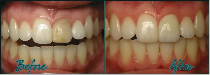 Dr. Burton Veener to correct dark tooth